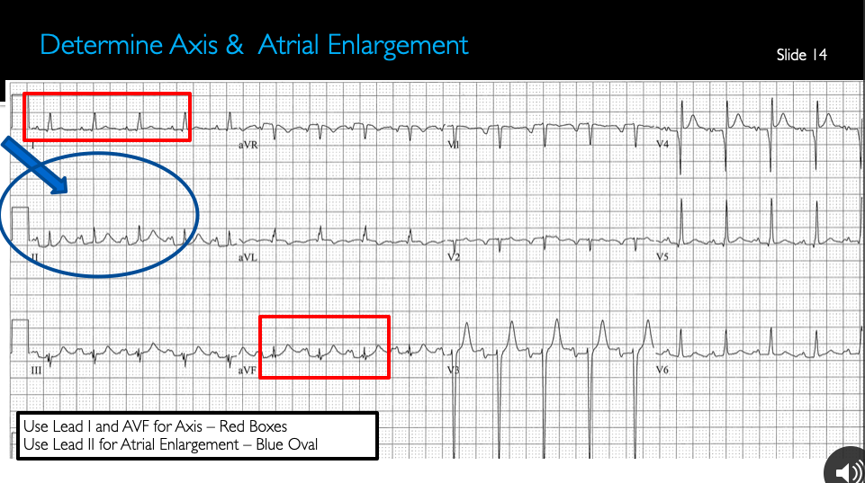 Solved Determine Axis & Atrial Enlargement Slide 14 A VA MI | Chegg.com