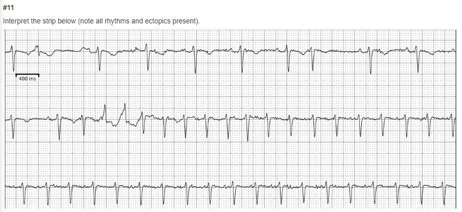 Solved Interpret the strip below (note all rhythms and | Chegg.com