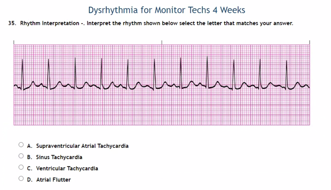 Solved Dysrhythmia for Monitor Techs 4 Weeks 35. Rhythm | Chegg.com