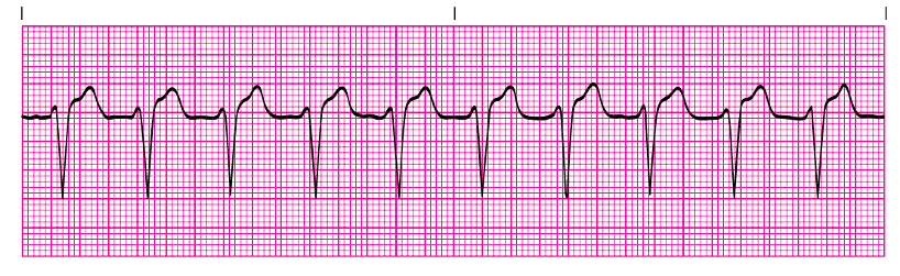 Solved What is the interpretation of these EKG | Chegg.com