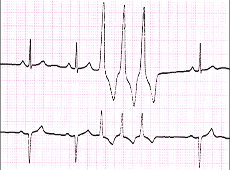 Solved Provide a complete diagnosis for this EKG. Possible | Chegg.com