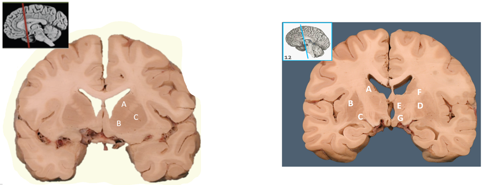 Label the regions of the brain shown in the diagram | Chegg.com