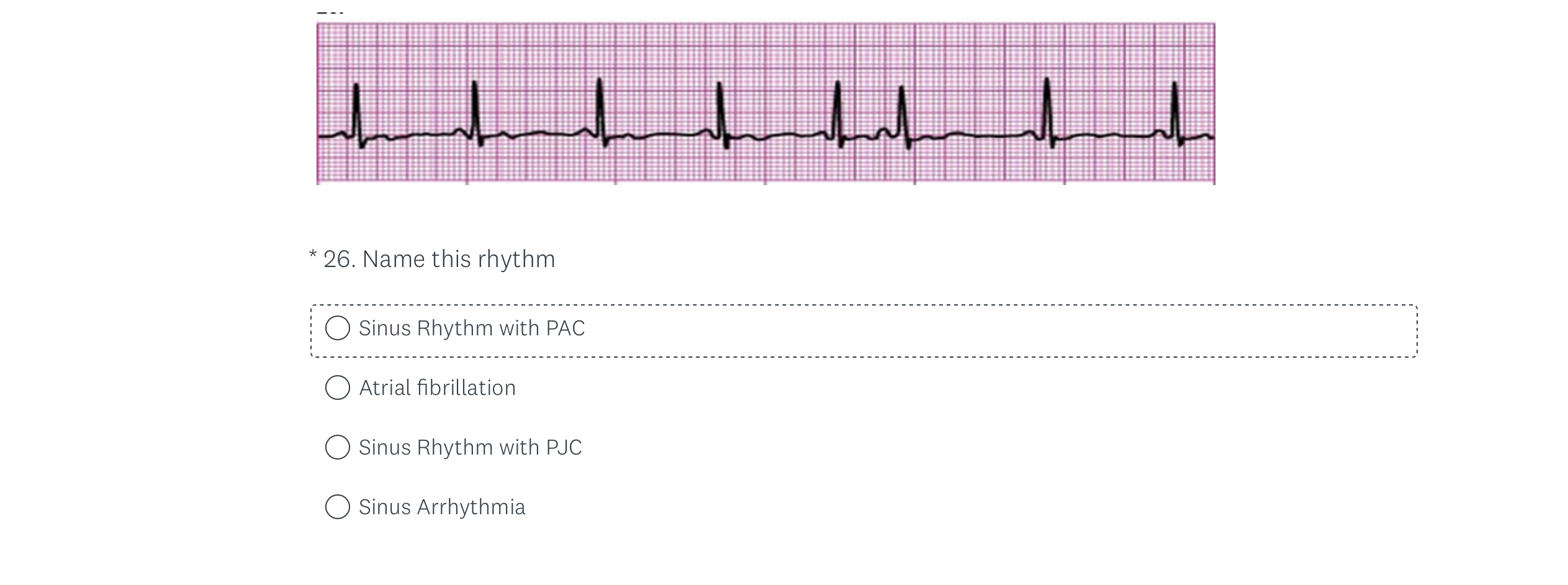 Solved Atrial fibrillation Sinus Rhythm with PJC Sinus | Chegg.com