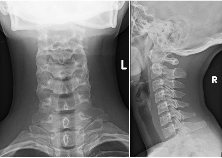 Solved This is a 24-year-old. She had reported neck pain | Chegg.com