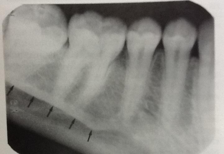 mylohyoid ridge radiograph