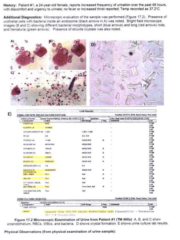 Solved Urinalysis Results (from the dipstick test and Figure