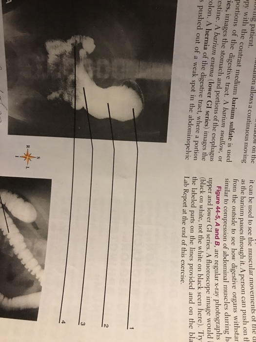 Solved Below is a radiography of a barium swallow or upper | Chegg.com