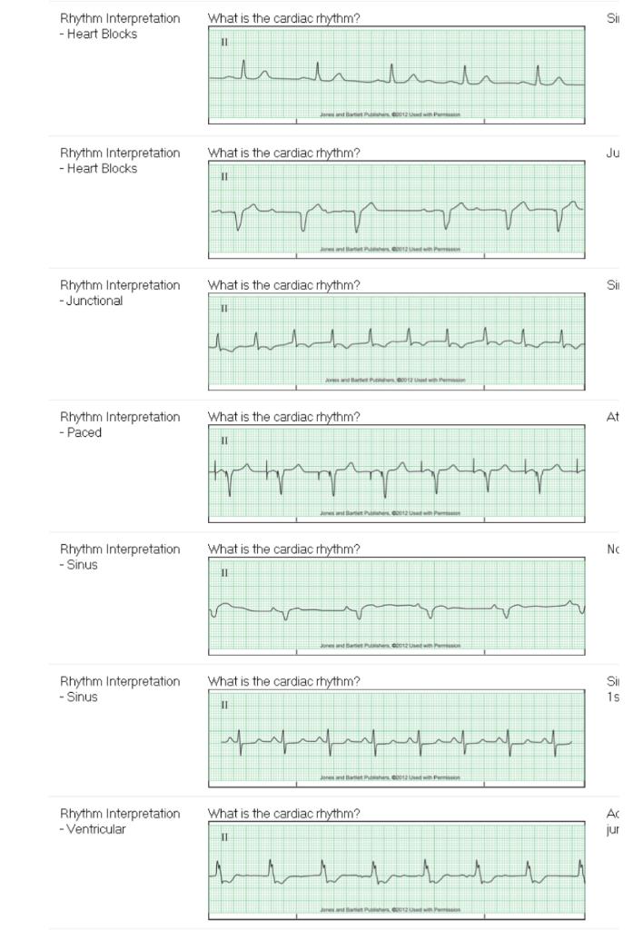 Solved Rhythm Interpretation Sii - Heart Blocks | Chegg.com