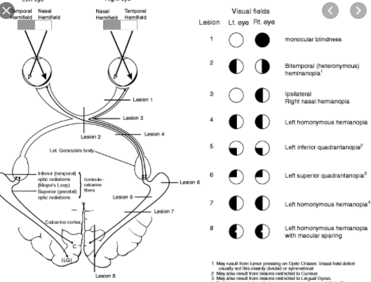 Solved temporal retina nasal retina optic nerve temporal | Chegg.com