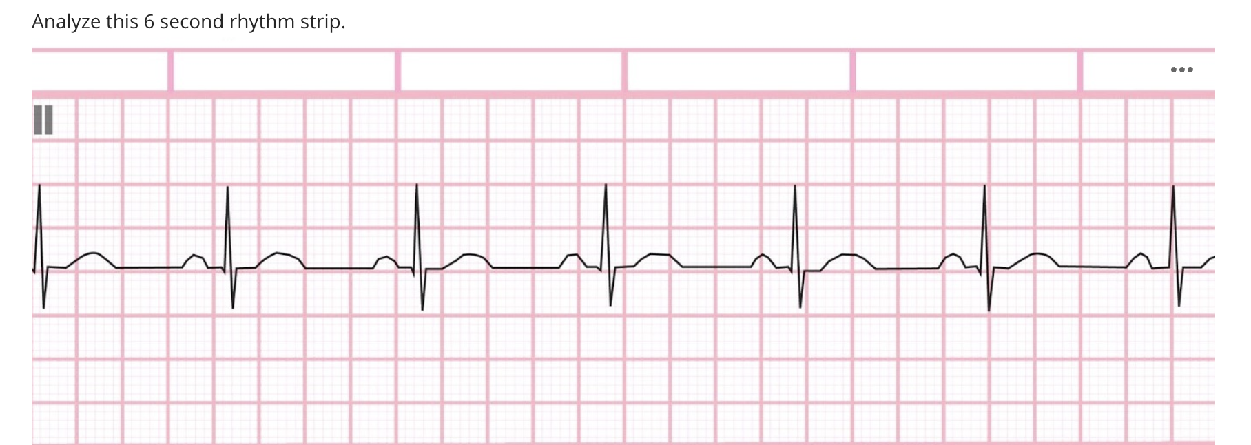 Analyze 6 ﻿second rhythm strip | Chegg.com