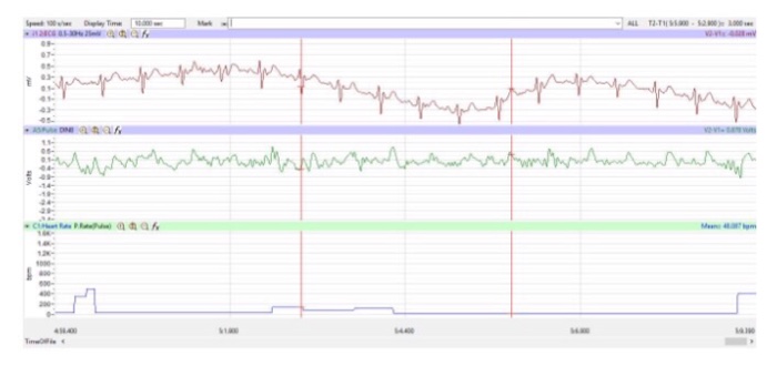 Solved How does the average T-P interval from rest to each | Chegg.com