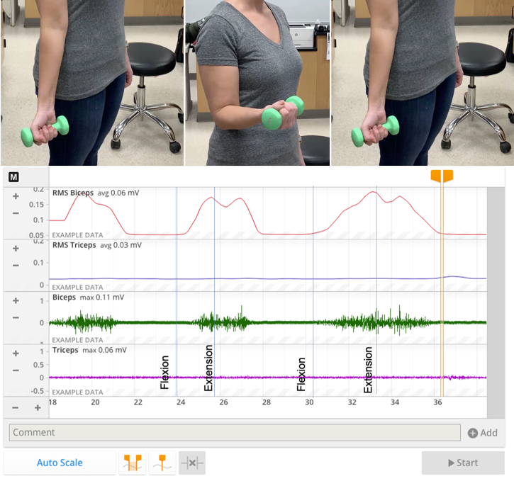 Displacements and EMG activity of the biceps, triceps and anterior and