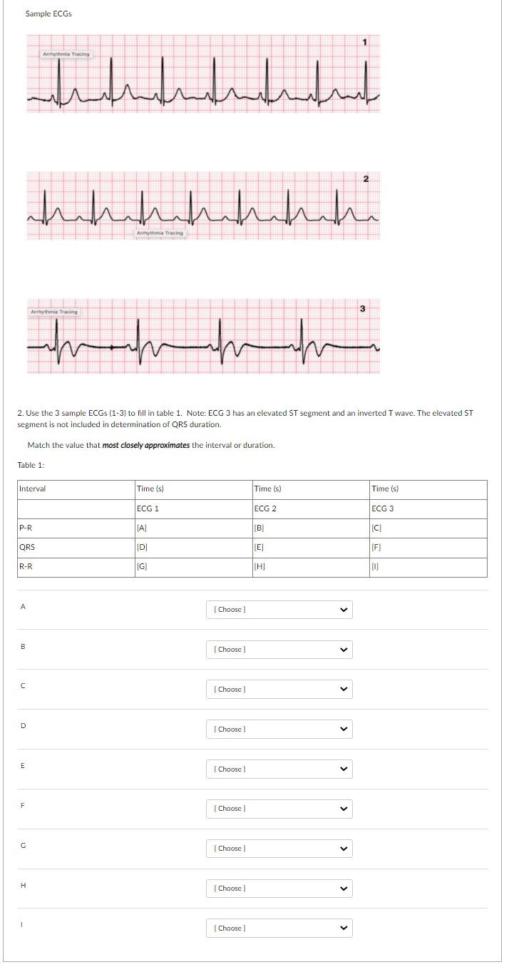 Solved Sample ECGS hhhhhhh hahhhhhh Arrhythmia Tracing Art | Chegg.com