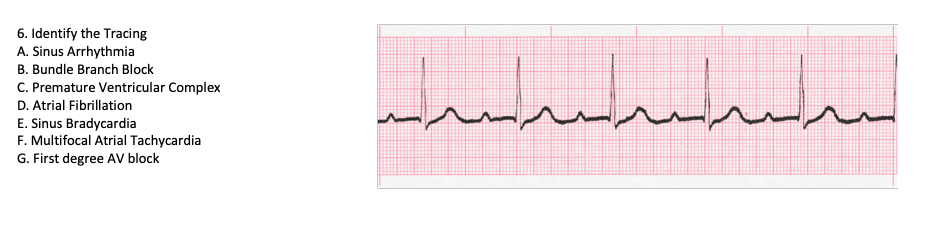 Solved 6. Identify the Tracing A. Sinus Arrhythmia B. Bundle | Chegg.com