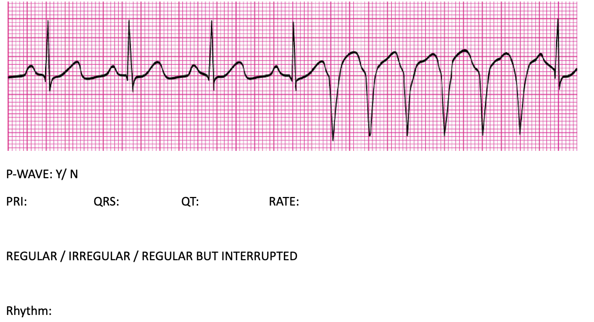 Solved P-WAVE: Y/ N PRI: QRS: QT: RATE: REGULAR / IRREGULAR | Chegg.com