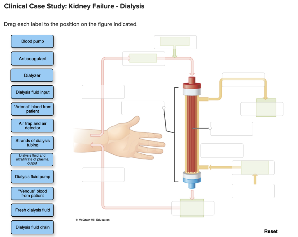 Solved Clinical Case Study Kidney Failure Dialysis Drag