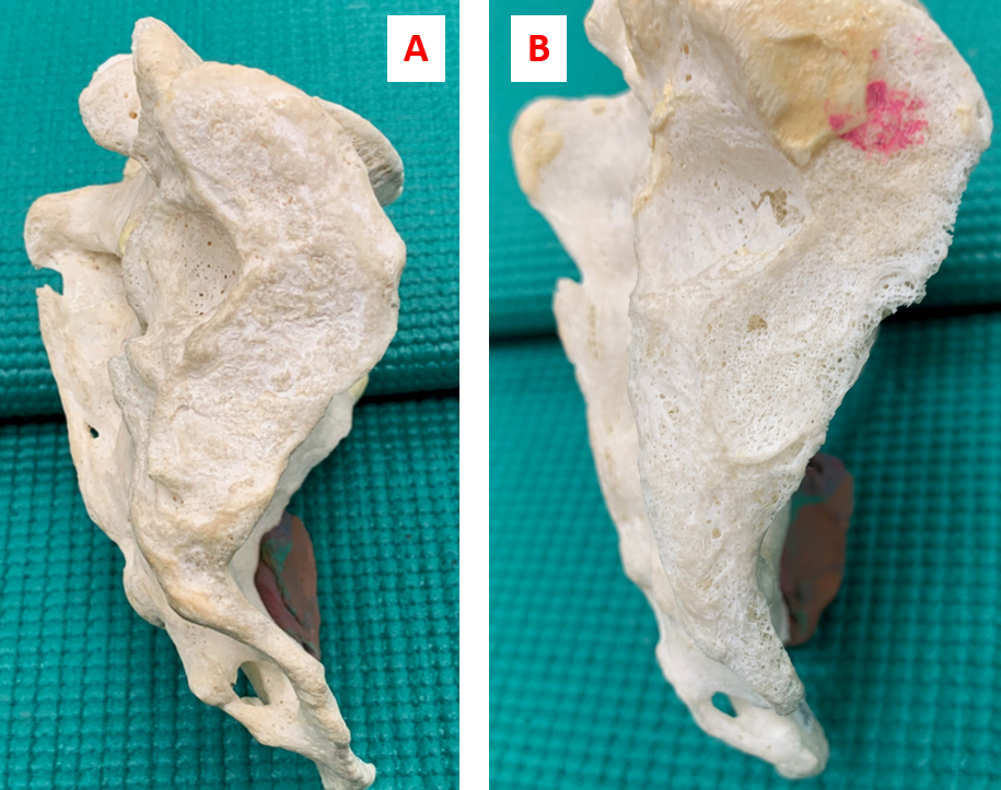 Solved Which of the following sacrum bones (A or B) is most | Chegg.com