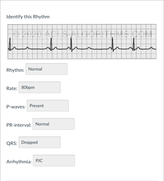 Solved Identify this Rhythm Rhythm Rate Pwaves