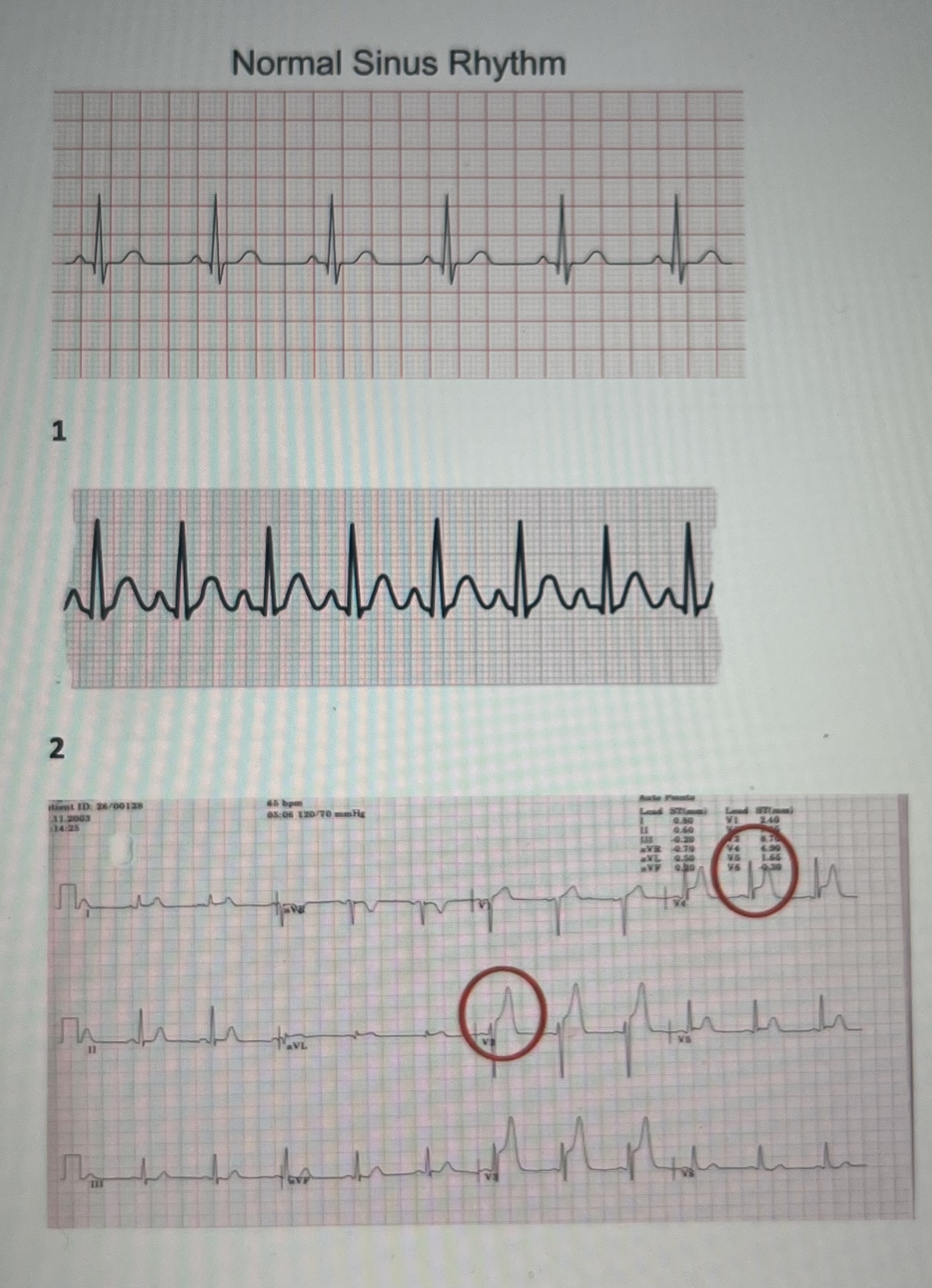 Solved After looking at the different EKG, please describe | Chegg.com