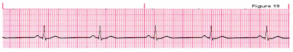 Solved Identify the letter choice that best fits the ECG | Chegg.com