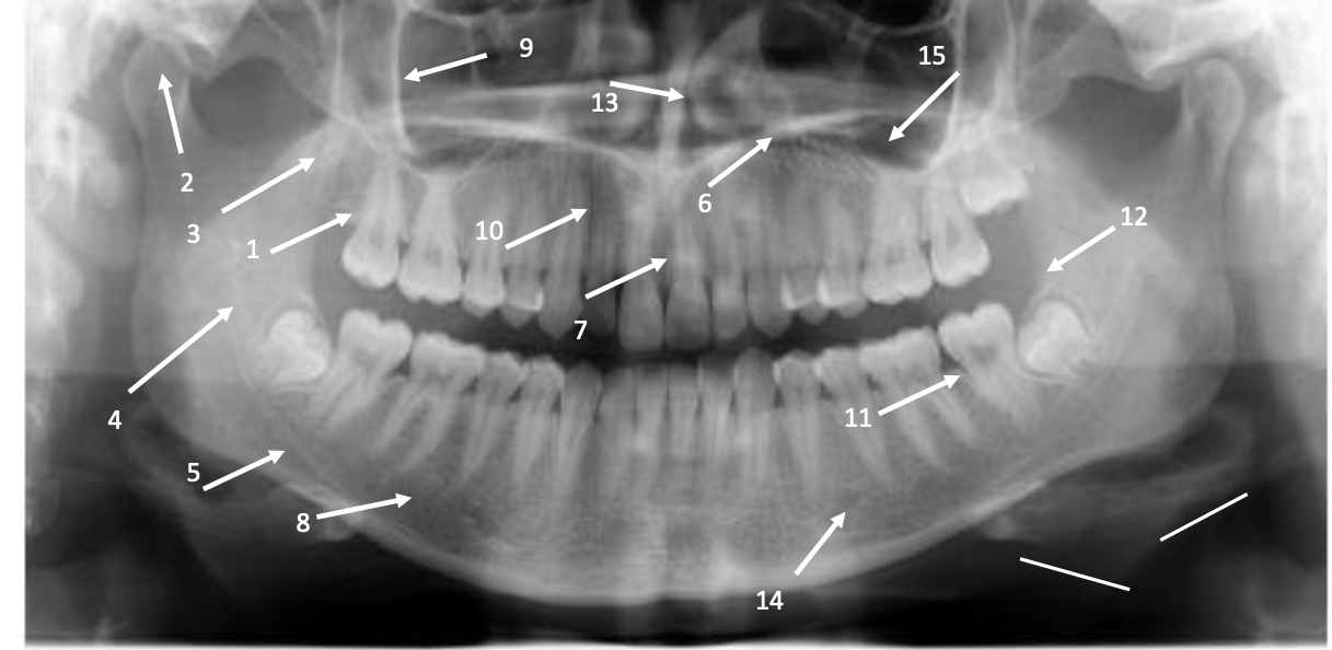 Solved Please correctly label this dental radiograph. Only | Chegg.com