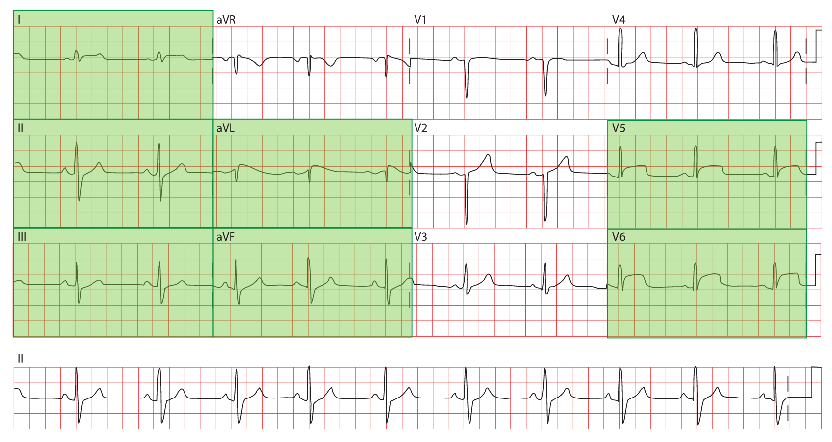 Solved Lateral infarction ST elevation will be seen in the | Chegg.com
