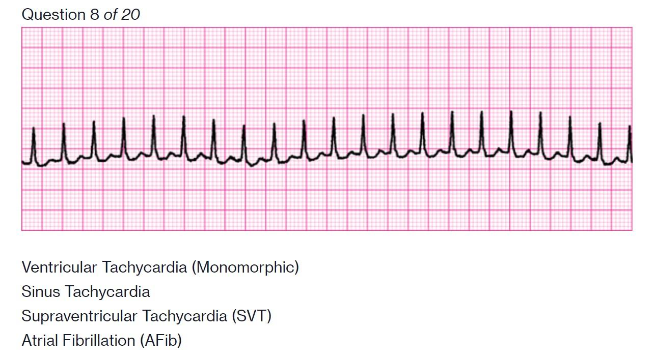 Solved Question 8 of 20 Пишшшшшш Ventricular Tachycardia | Chegg.com