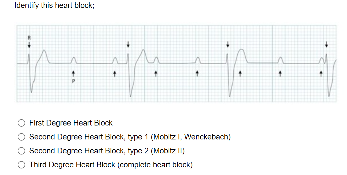 Solved Identify this heart block; ju ↑ ↑ P First Degree | Chegg.com