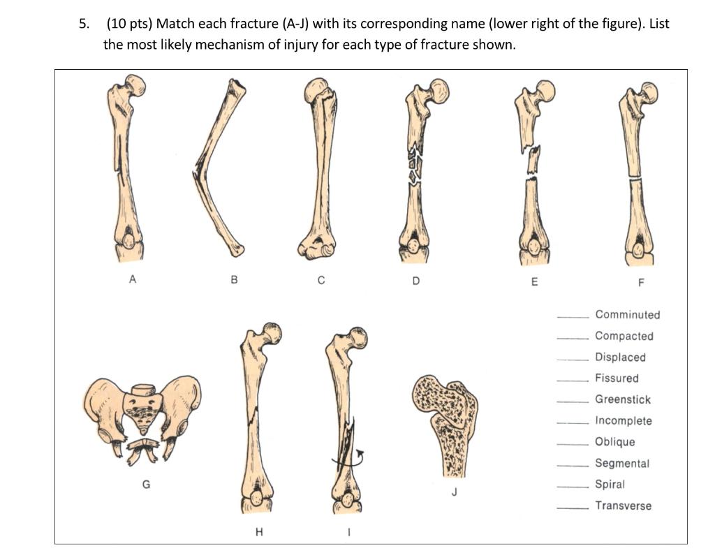 5. (10 pts) Match each fracture (AJ) with its