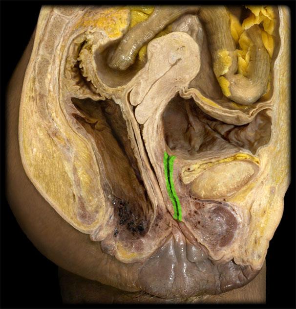 bladder dissection