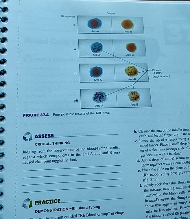 solved-serum-blood-type-antha-anti-b-anti-b-clumps-of-rbcs-chegg