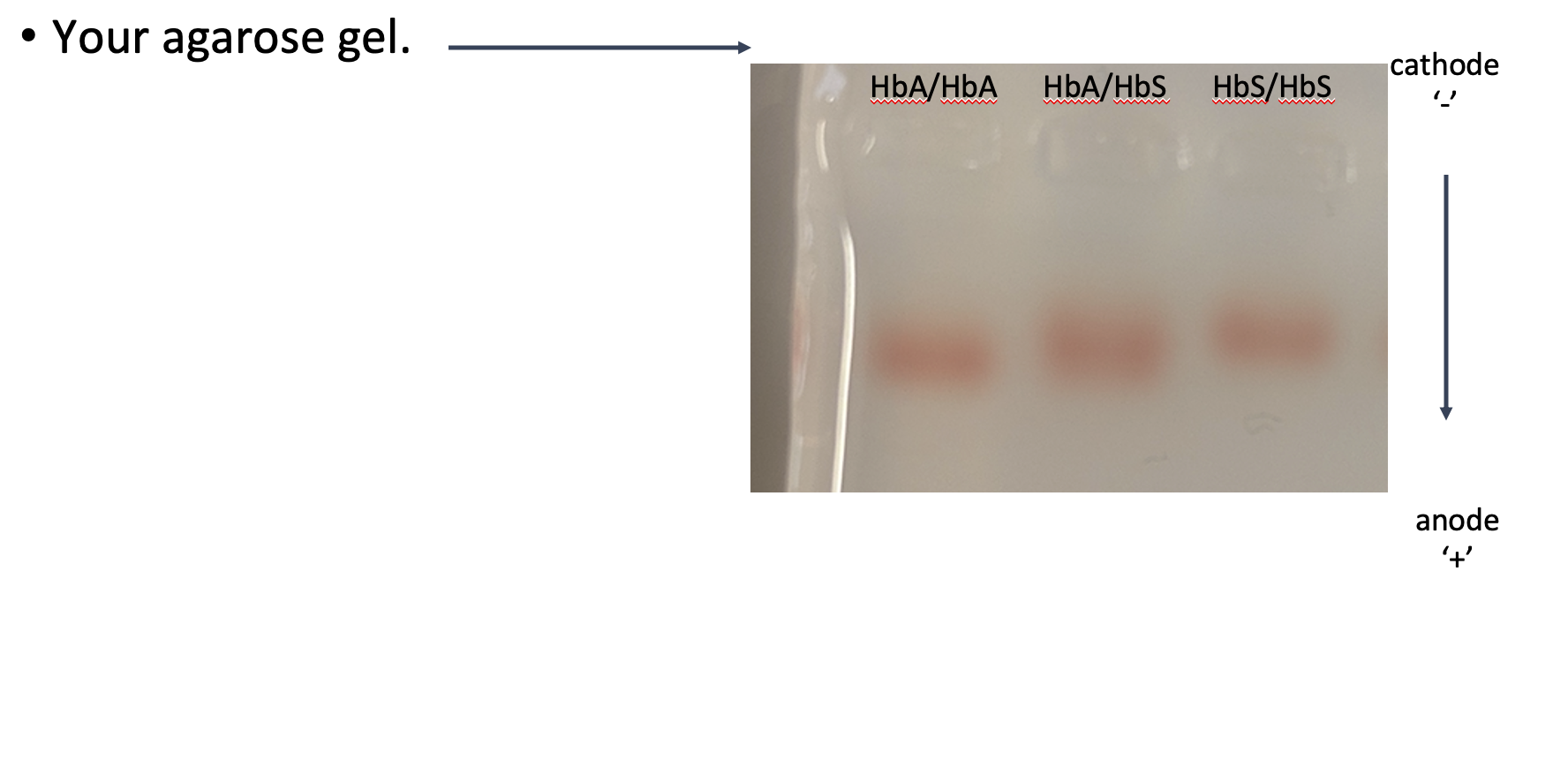 Solved • Your Agarose Gel. Cathode HbA/HbA HbA/HbS Hbs/HbS | Chegg.com