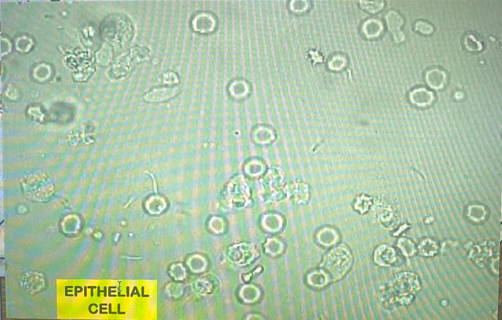 Solved Urinalysis Microscopic Observation. Looking for # of | Chegg.com