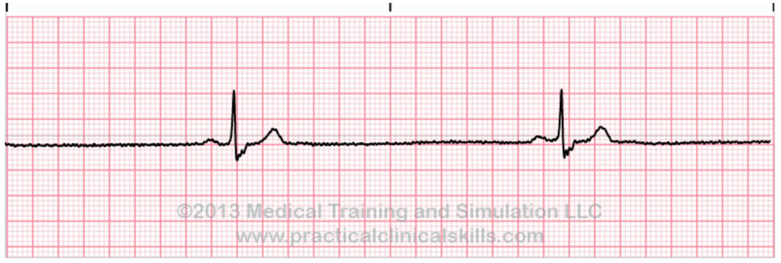 Ekg Flashcards Chegg Com