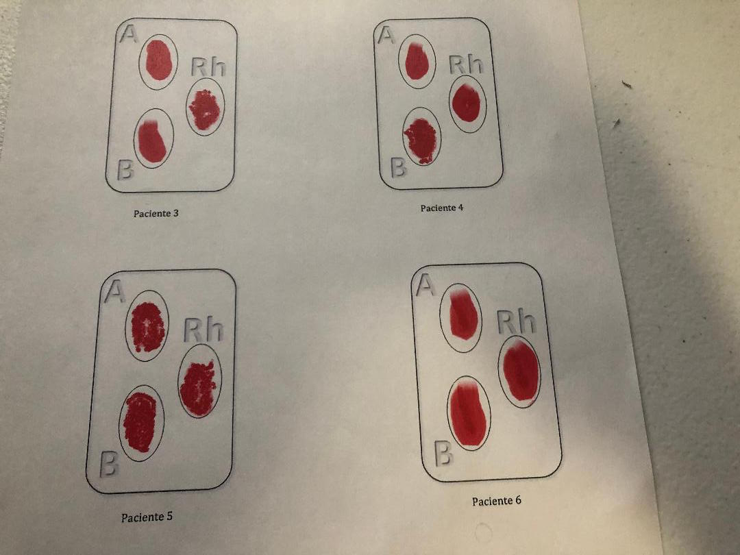 Solved (A Rh Rh B Paciente 3 Paciente 4 (A Rh Rh B. B | Chegg.com