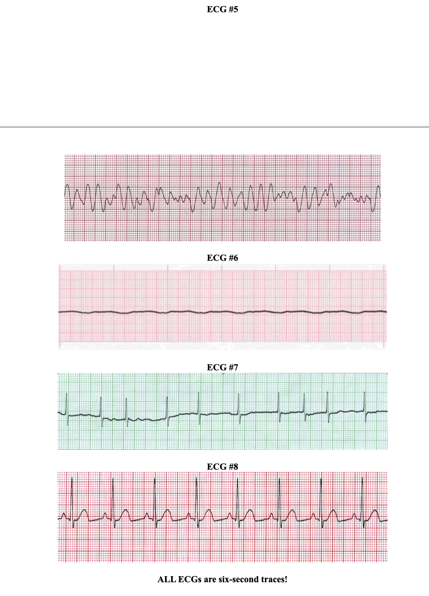 Solved Normal Sinus Rhythm (NSR) Identify the ECGs with | Chegg.com