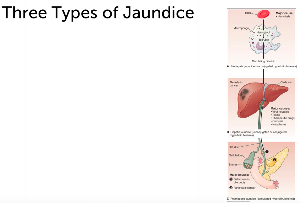 Jaundice Diagram