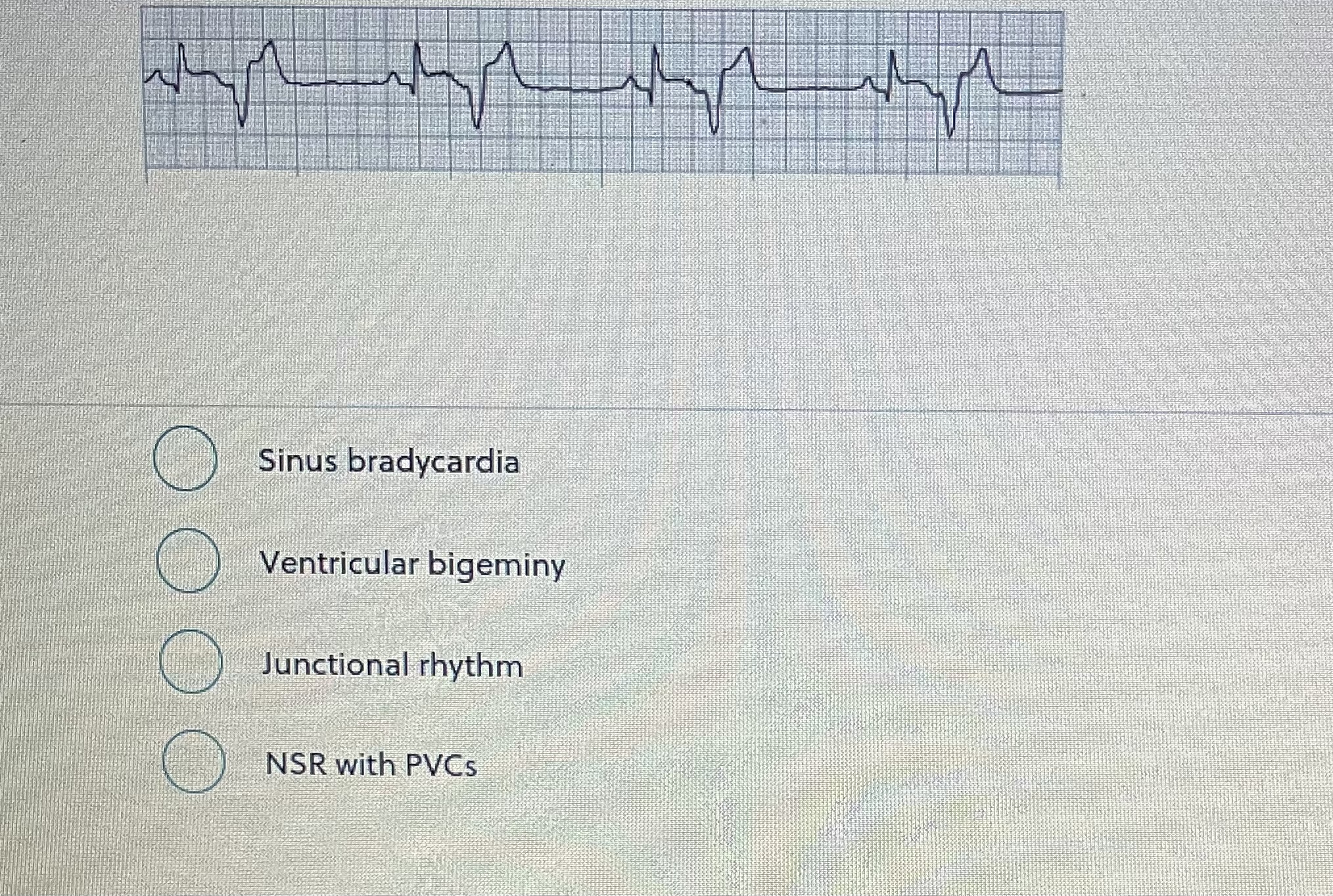 solved-sinus-bradycardia-ventricular-bigeminy-junctional-chegg