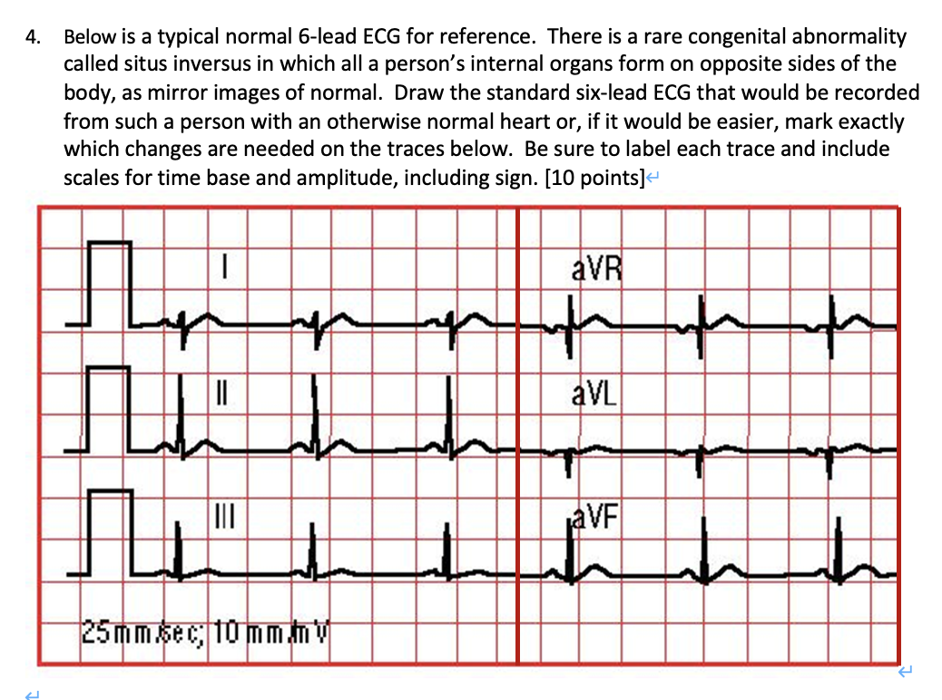 Solved Below is a typical normal 6-lead ECG for reference. | Chegg.com