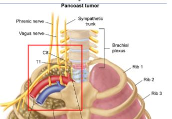 pancoast tumor neck