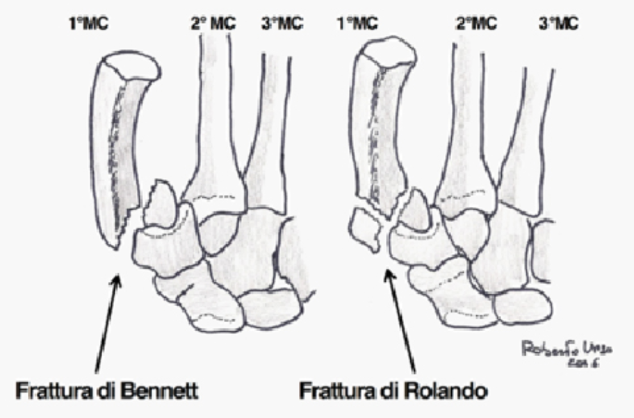 Orto Fratture E Lesioni Parti Molli Aims Flashcards Chegg Com
