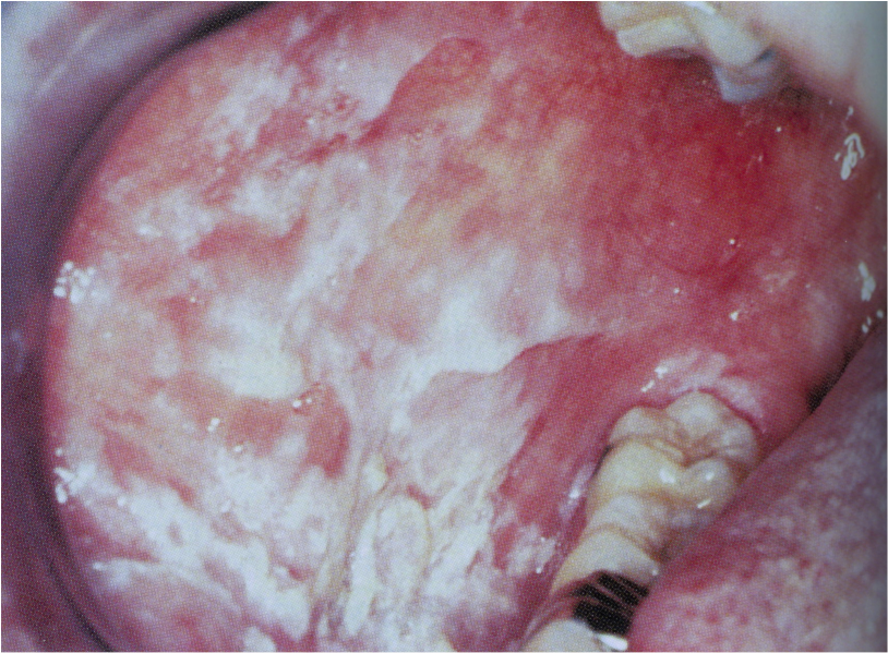 hereditary benign intraepithelial dyskeratosis