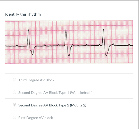 Solved Identify This Rhythm Third Degree Av Block Second 