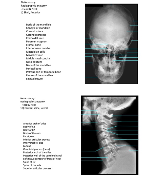 Lateral Neck Radiograph Anatomy