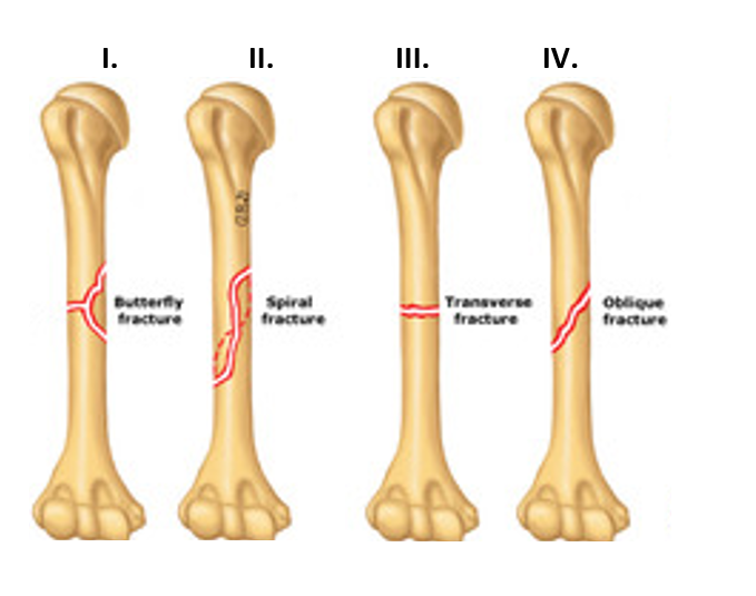 Solved Because bone is a brittle material, when it fails it | Chegg.com