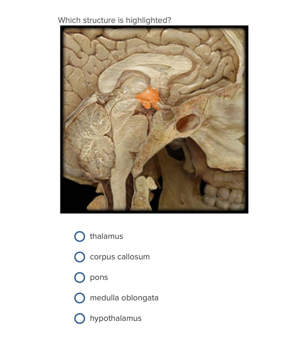 solved-which-structure-is-highlighted-third-ventricle-chegg