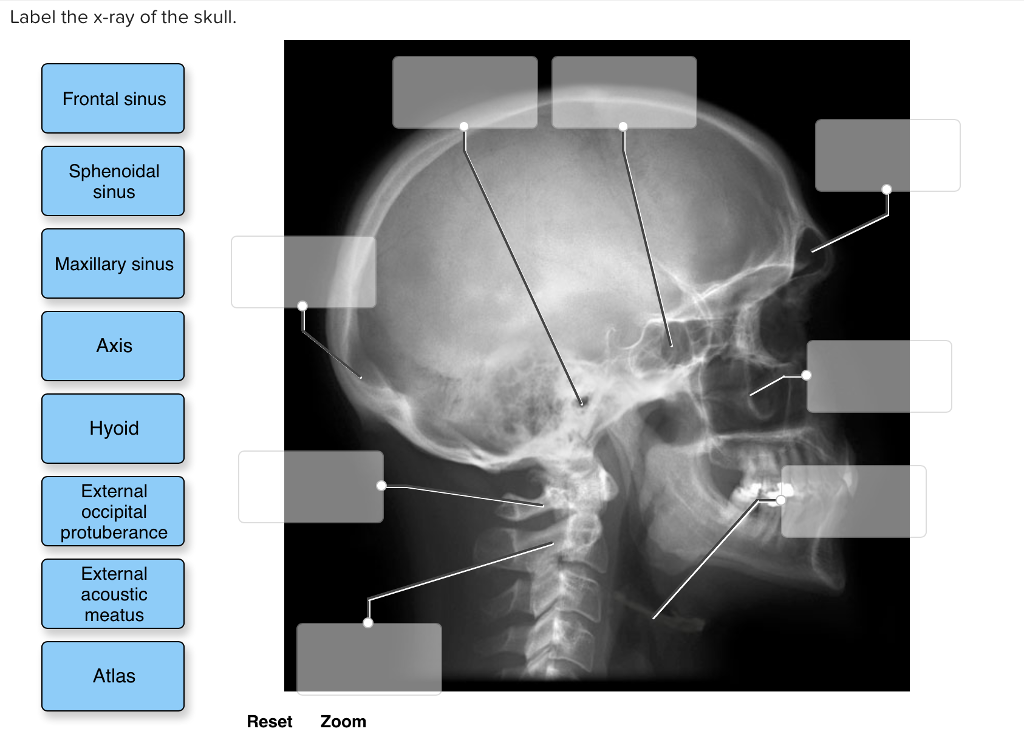 Solved Label the xray of the skull. Frontal sinus