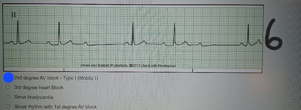 Solved 2nd degree AV block - Type I (Mobitz I) 3rd degree | Chegg.com