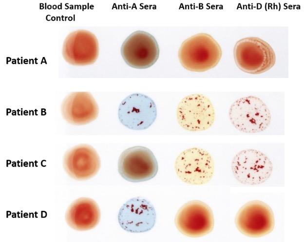 Solved Identify the blood type of Patient A. | Chegg.com