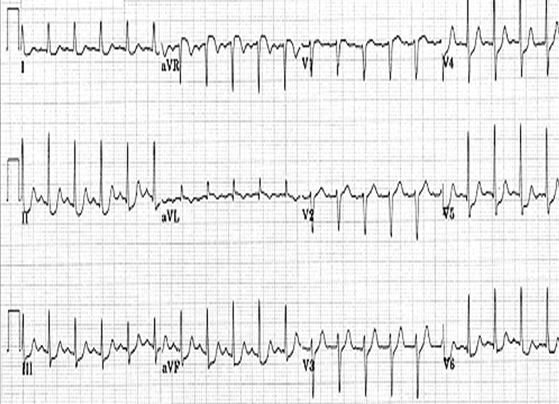 Solved Provide a complete diagnosis for this EKG. Possible | Chegg.com